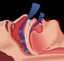 Fisiologia da Apneia do Sono: O Que Acontece em Nosso Corpo