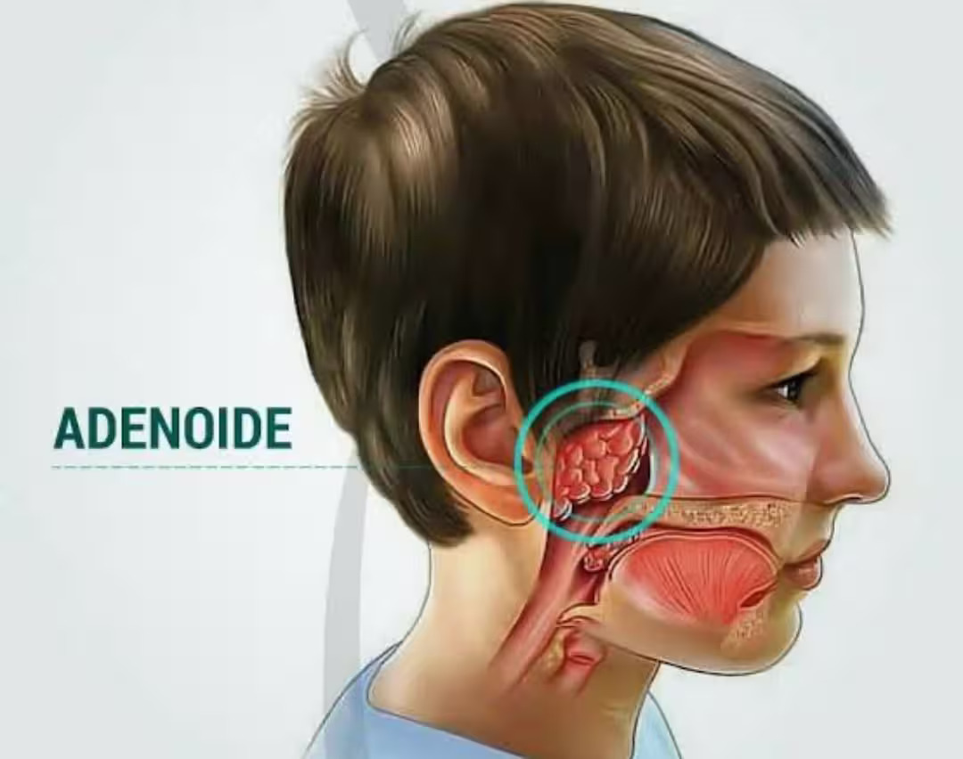 Cirurgia da adenoide e amígdalas em crianças