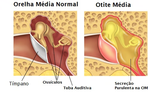 Otite média serosa: líquido acumulado atrás do tímpano