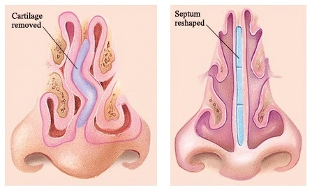 Correção do desvio de septo com septoplastia