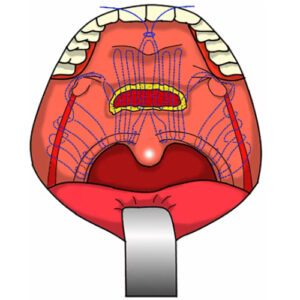 Cirurgia para apneia do sono com uso de sutura barbada