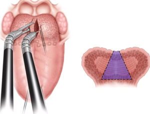 Cirurgia de apneia do sono feita com auxílio do robô DaVinci