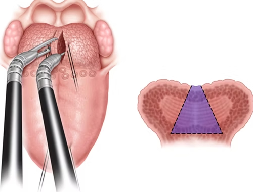 Cirurgia do ronco e da apneia do sono: o que é, como funciona e quando fazer