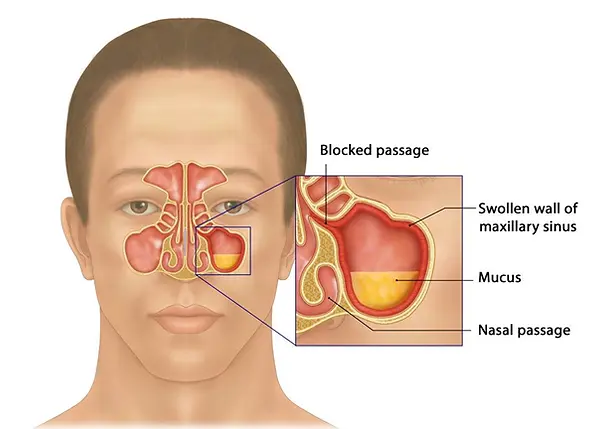Ilustração da rinossinusite crônica mostrando a inflamação dos seios paranasais